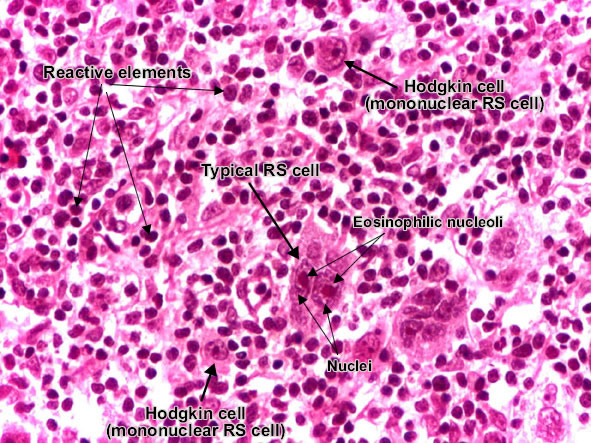 Reed-Sternberg cell Reed-Sternberg cell