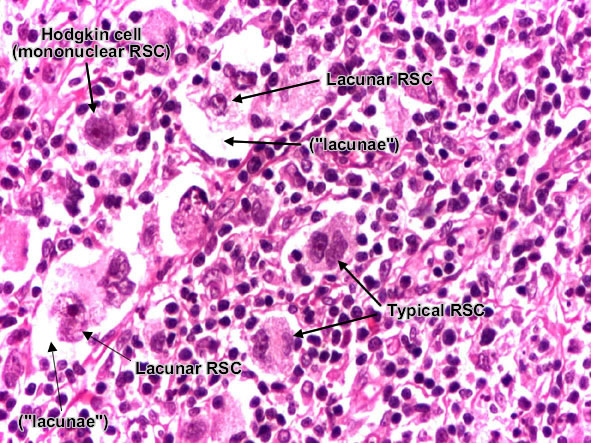 Reed-Sternberg cell (2)