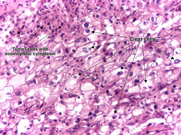 Renal cell carcinoma (Grawitz tumor) Renal cell carcinoma (Grawitz tumor)