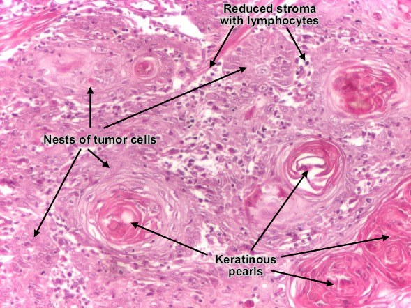 Squamous cell carcinoma (skin)