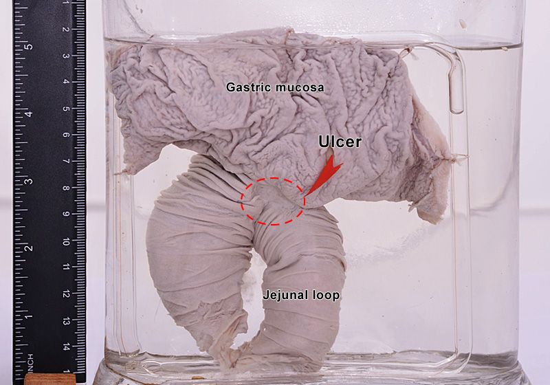 Stomal chronic peptic ulcer