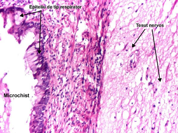 Teratomul microchistic matur (ovar)