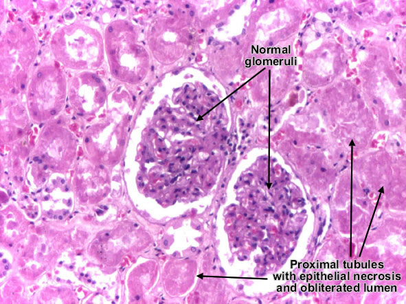 Toxic tubular necrosis