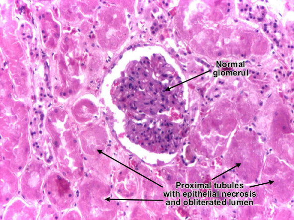 Toxic tubular necrosis