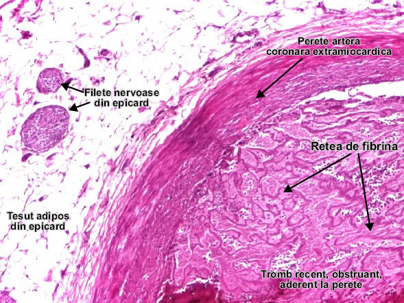 Tromboza recenta artera coronara