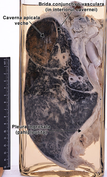 Tuberculoza secundara - caverna veche cu brida conjunctivo-vasculara