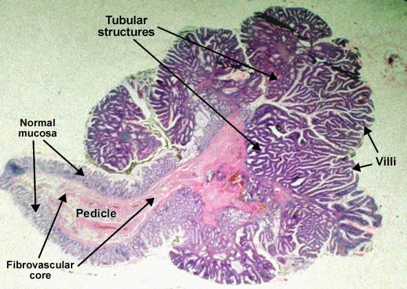 Tubulo-villous adenoma (Pedunculated polyp)