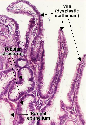 Adenomatous tubulo-villous polyp (colon) - detail