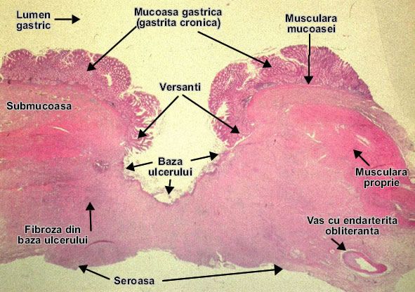 Ulcer peptic cronic gastric