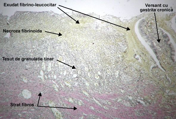 Ulcer peptic cronic