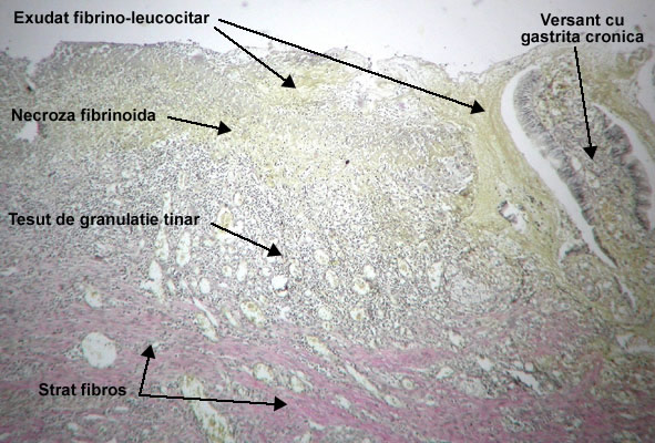 Versant van Gieson - ulcerul peptic cronic